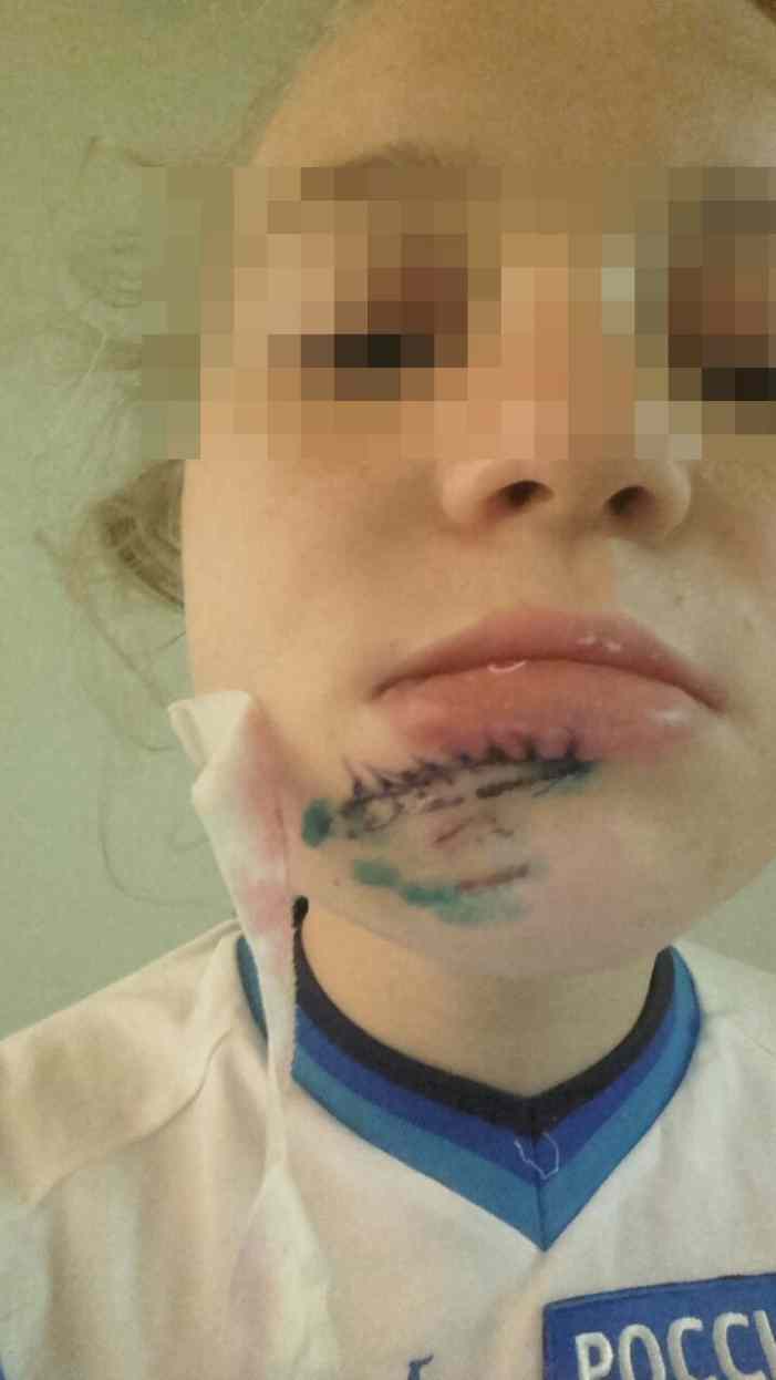 Ужасы московских квестов: 12-летняя девочка изуродовала лицо